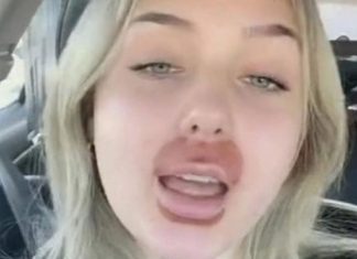 Se hizo un tratamiento en los labios y le quedaron como a Homero Simpson