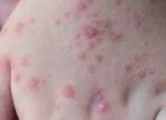 Argentina: detectaron el primer caso sospechoso de viruela de mono